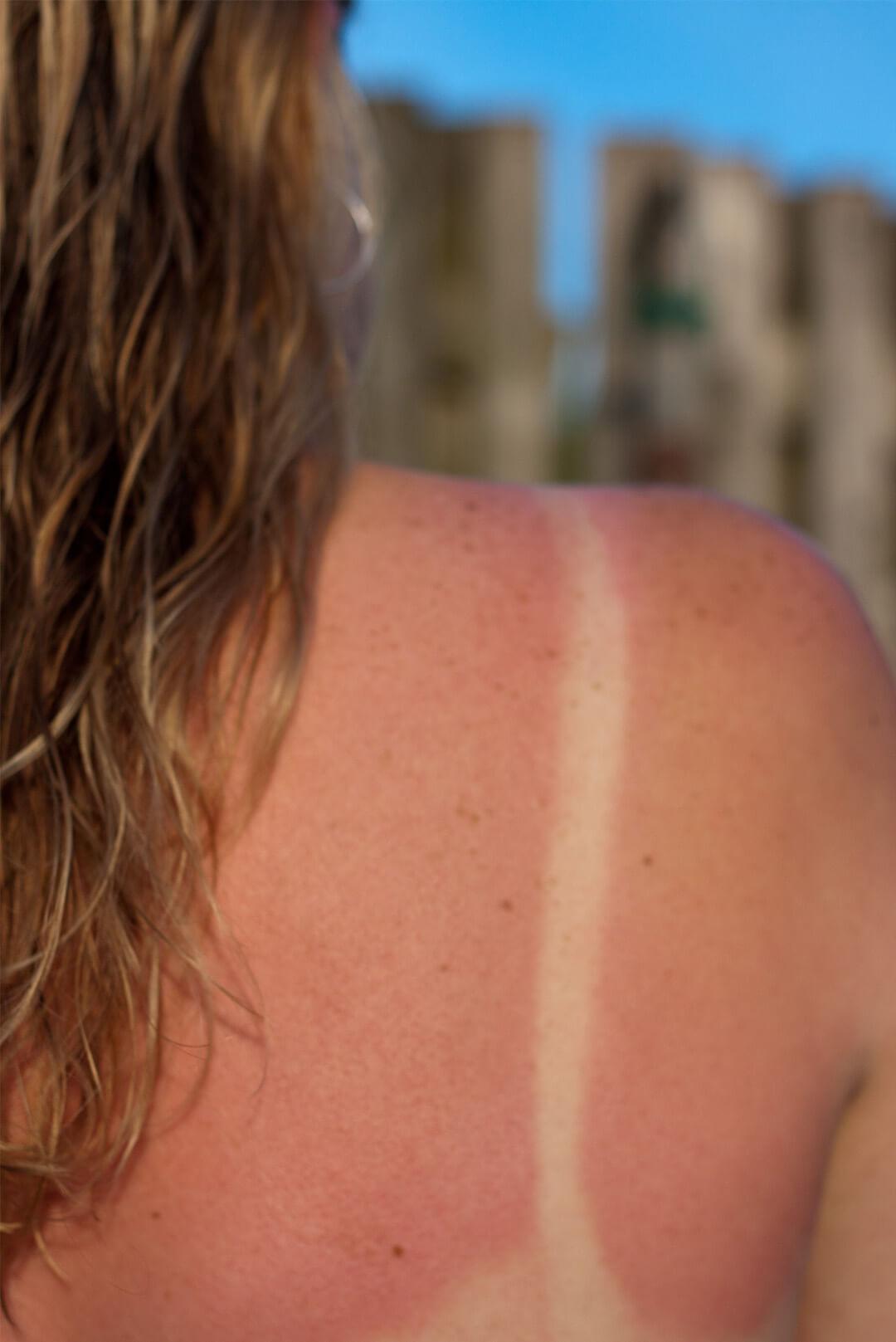 Sunburned woman back Desktop